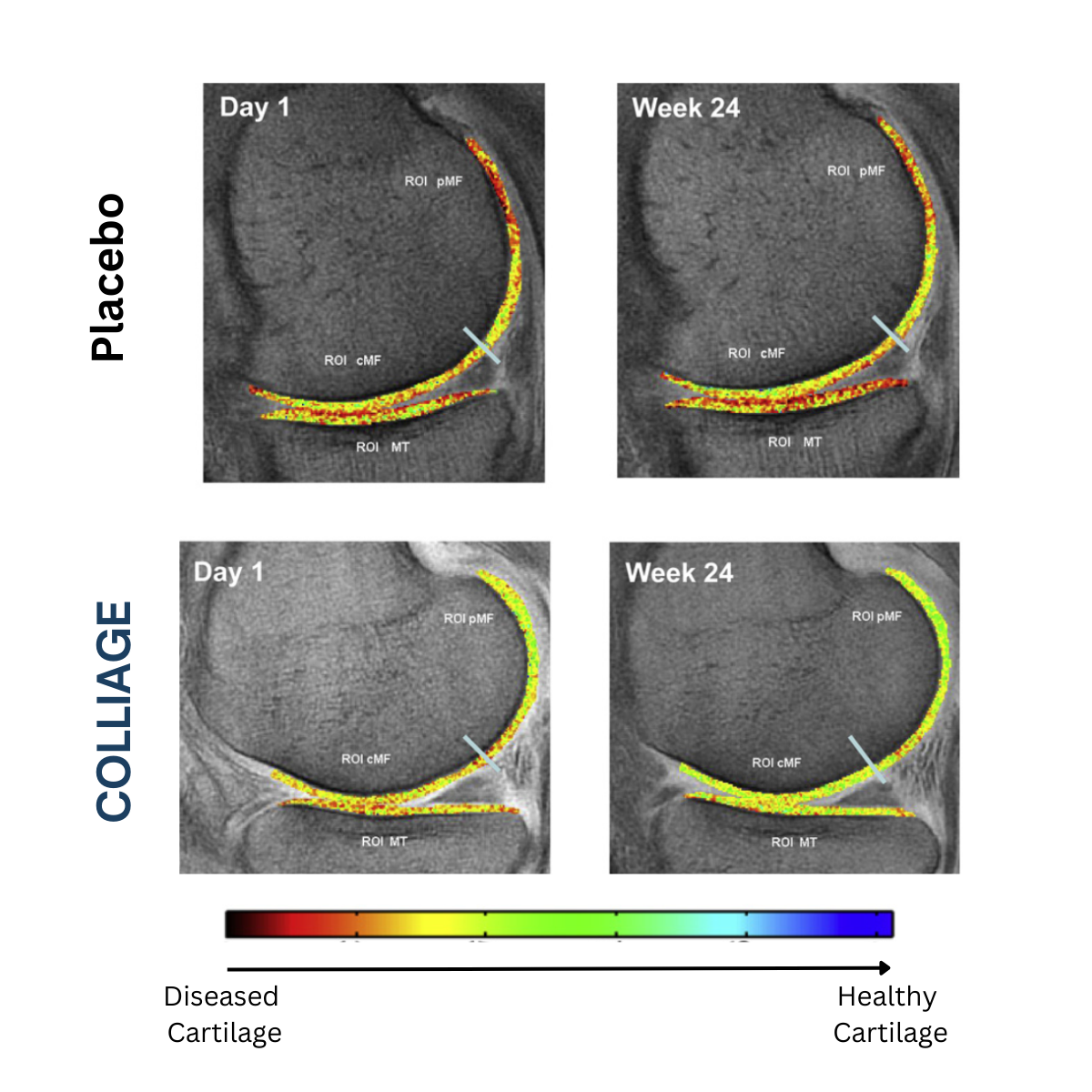 MRI images of knees from patients with mild knee osteoarthritis, comparing before and after 24 weeks of treatment with Colliage collagen peptides or placebo. The Colliage-treated patient shows increased proteoglycan density, highlighting joint regeneration benefits.